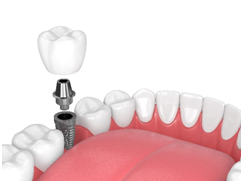 Dental implants Vs Dentures