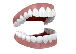 Dental implants Vs Dentures