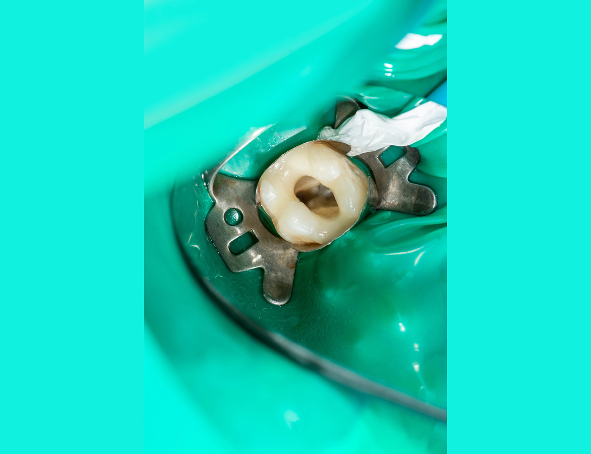 Root canal treatment