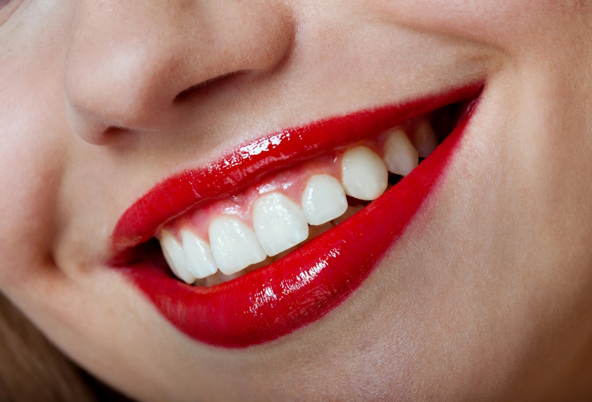 Smile Makeover
