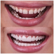 veneers