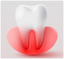 Gum disease