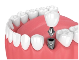 dental implant